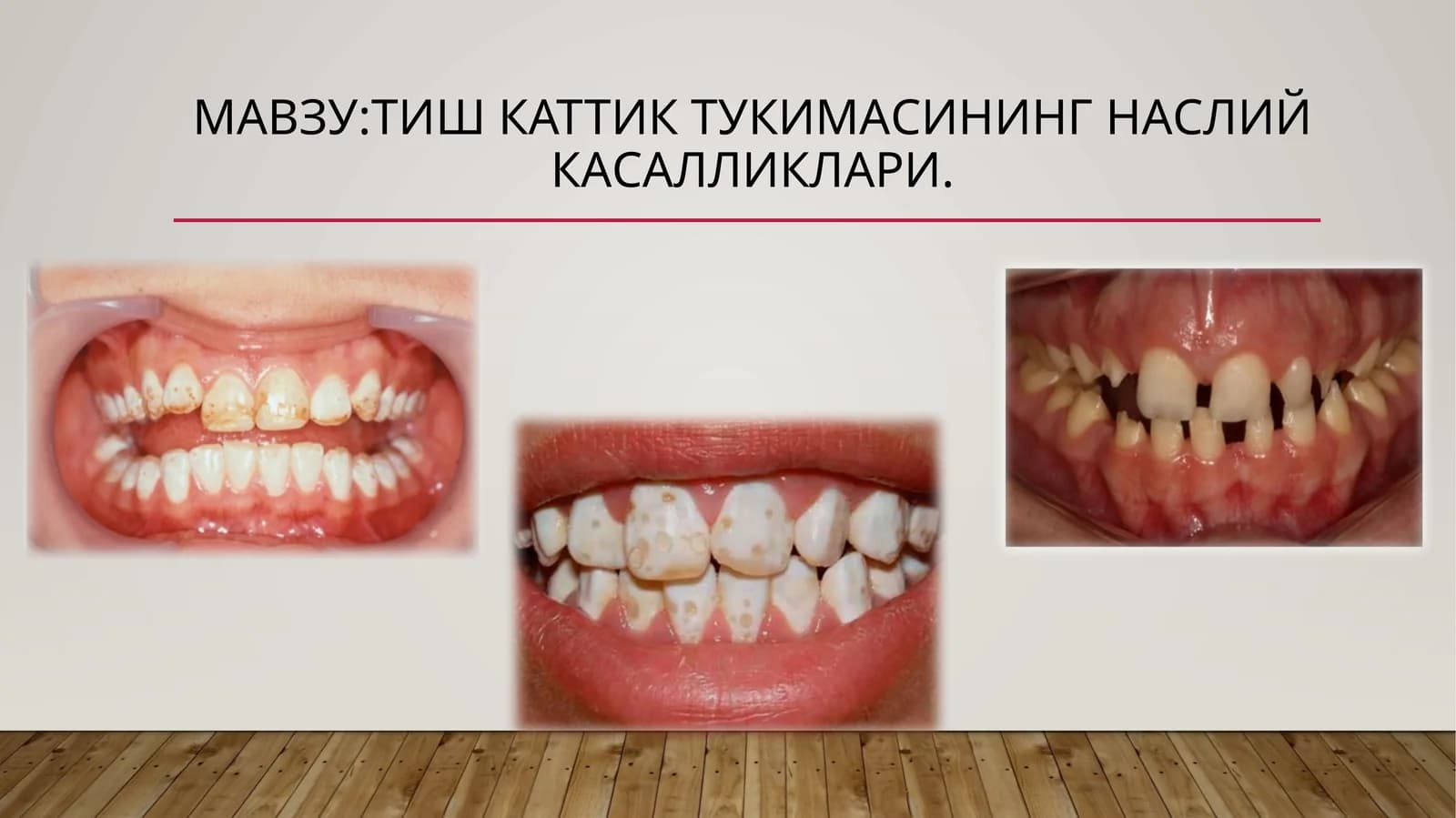Тиш каттик тукимасининг наслий касалликлари