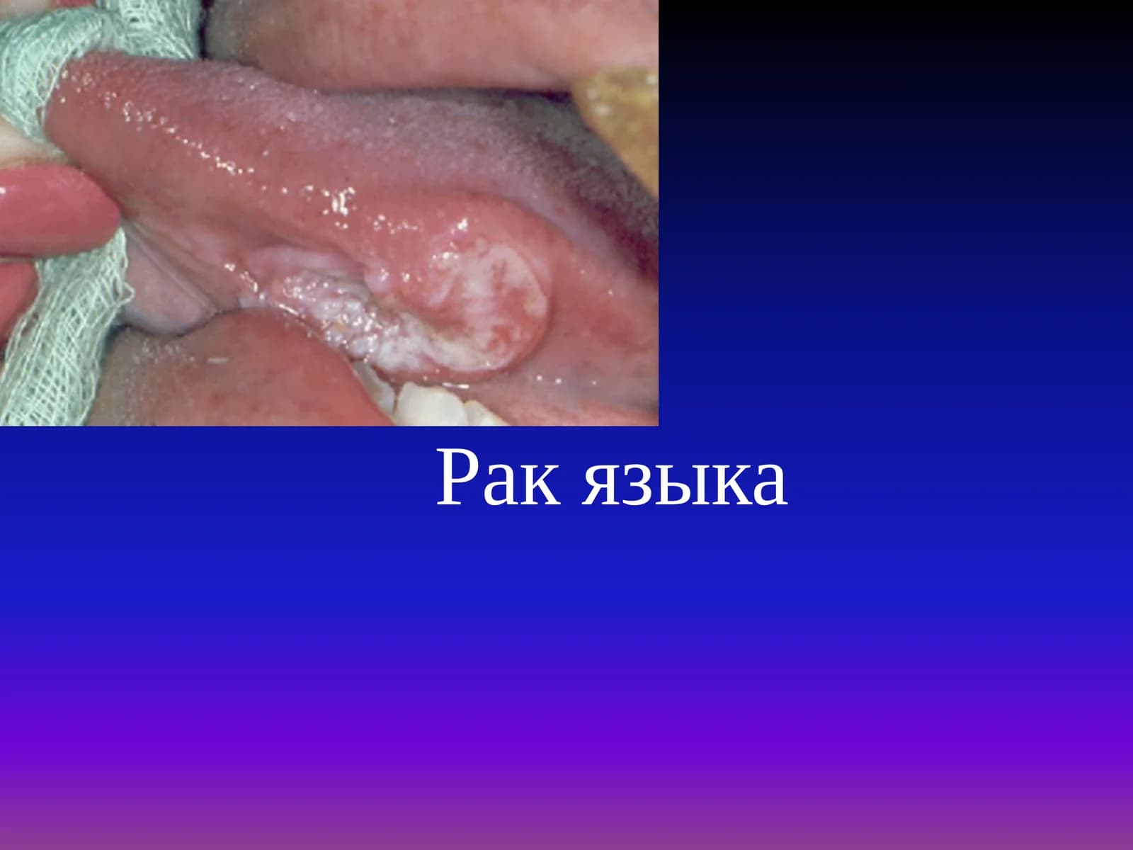 Рак корня языка