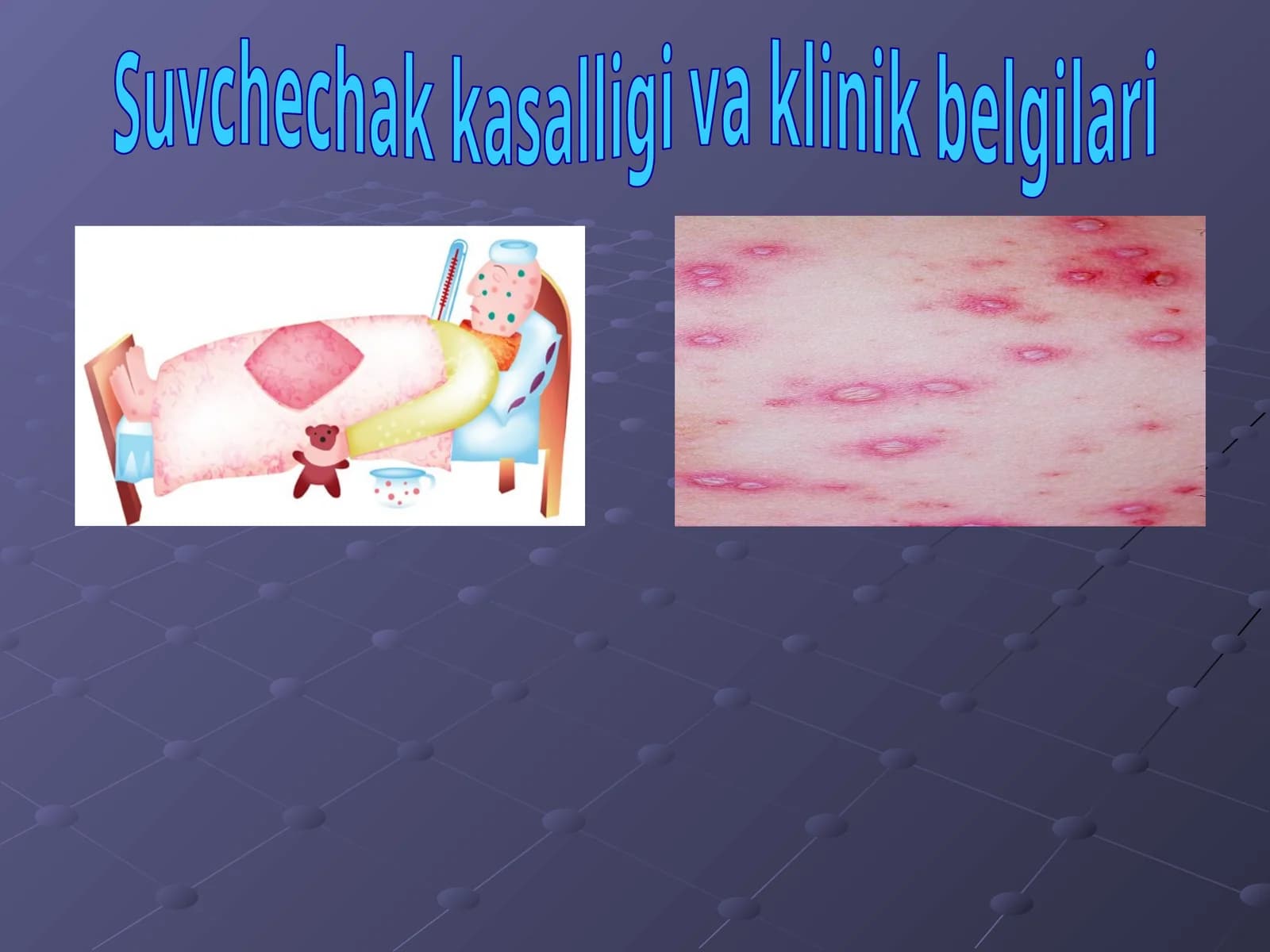 Suvchechak kasalligi va klinik belgilari