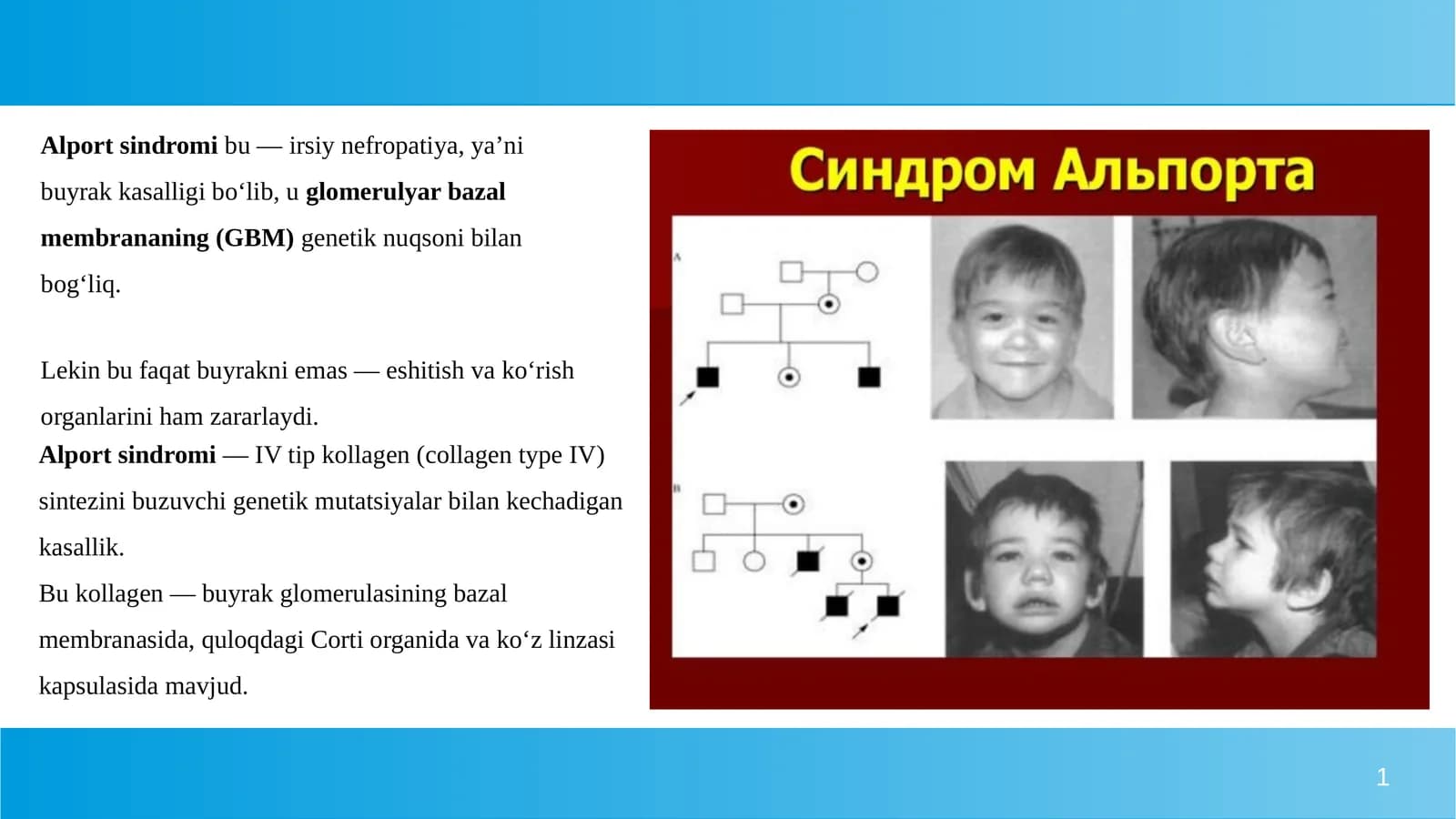 Alport sindromi