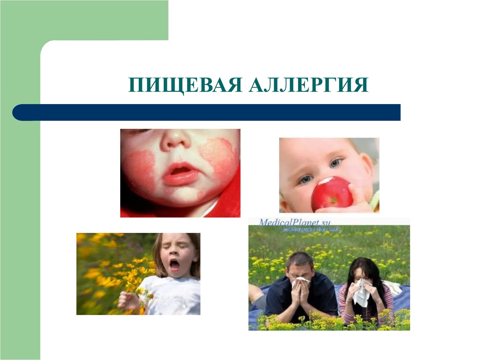 ПИЩЕВАЯ АЛЛЕРГИЯ