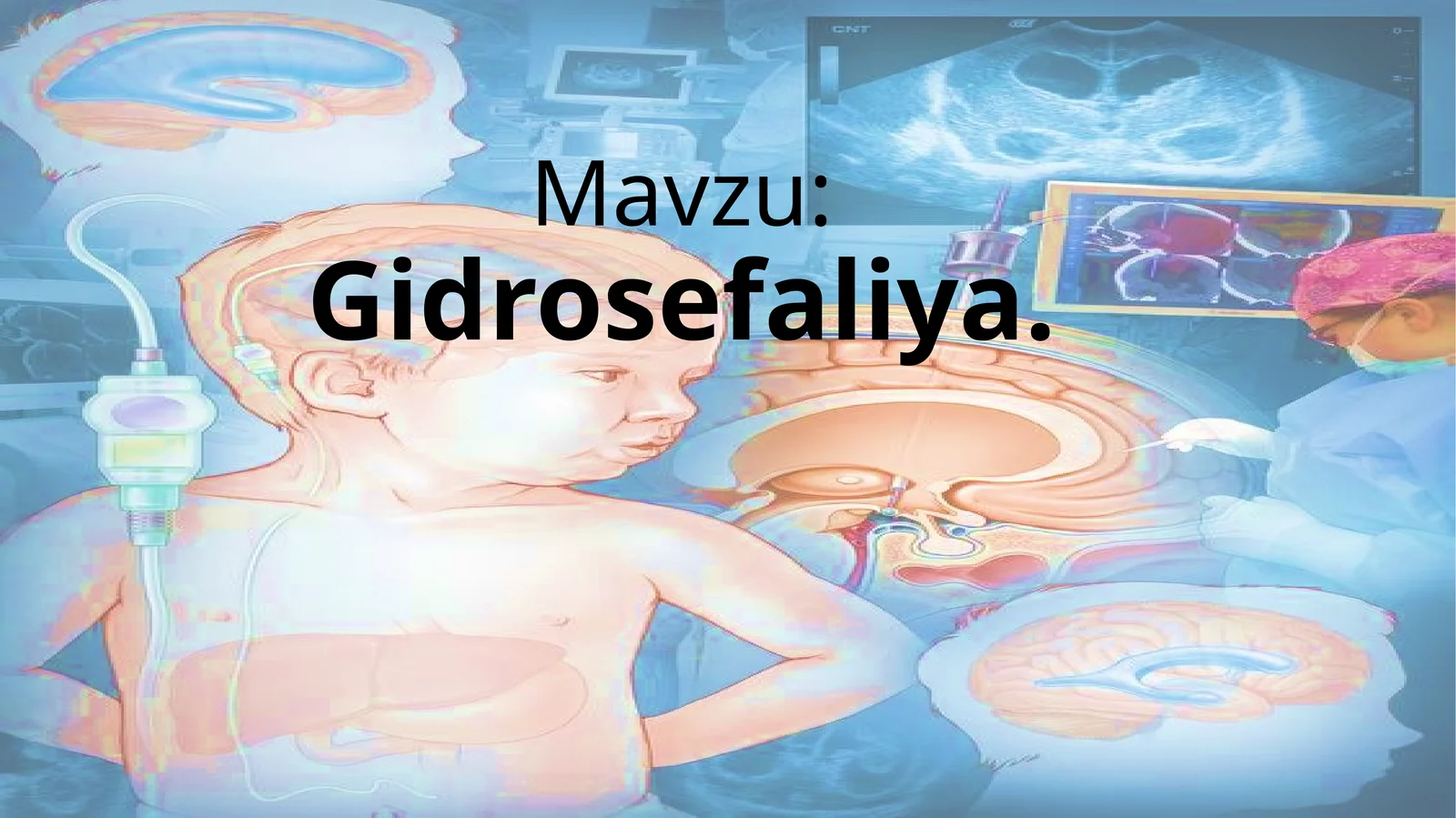 Gidrosefaliya