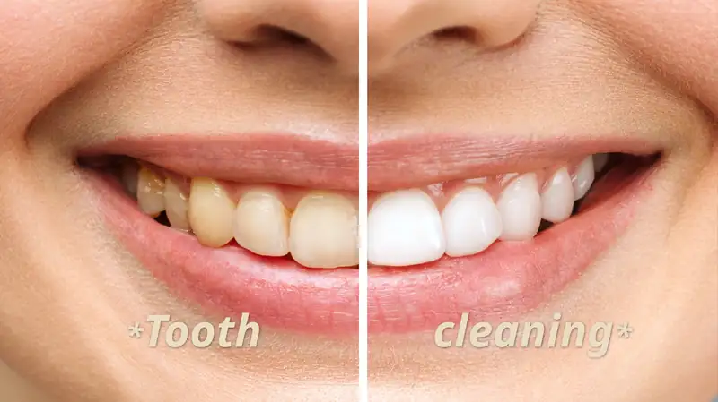 Tooth  cleaning