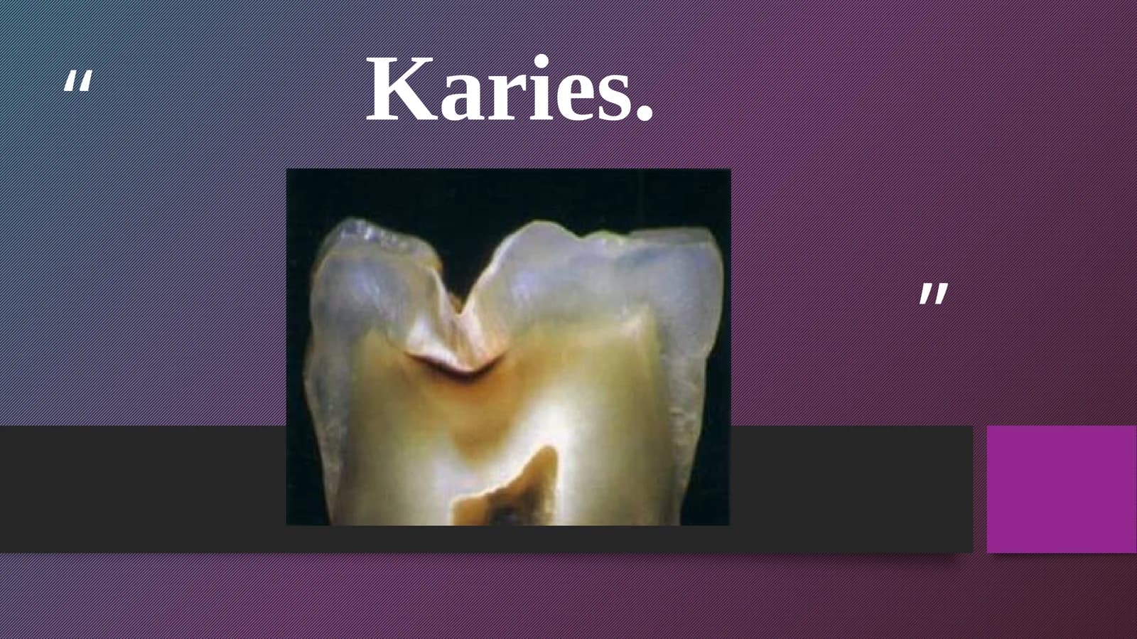 Karies haqida pirizintatsiya