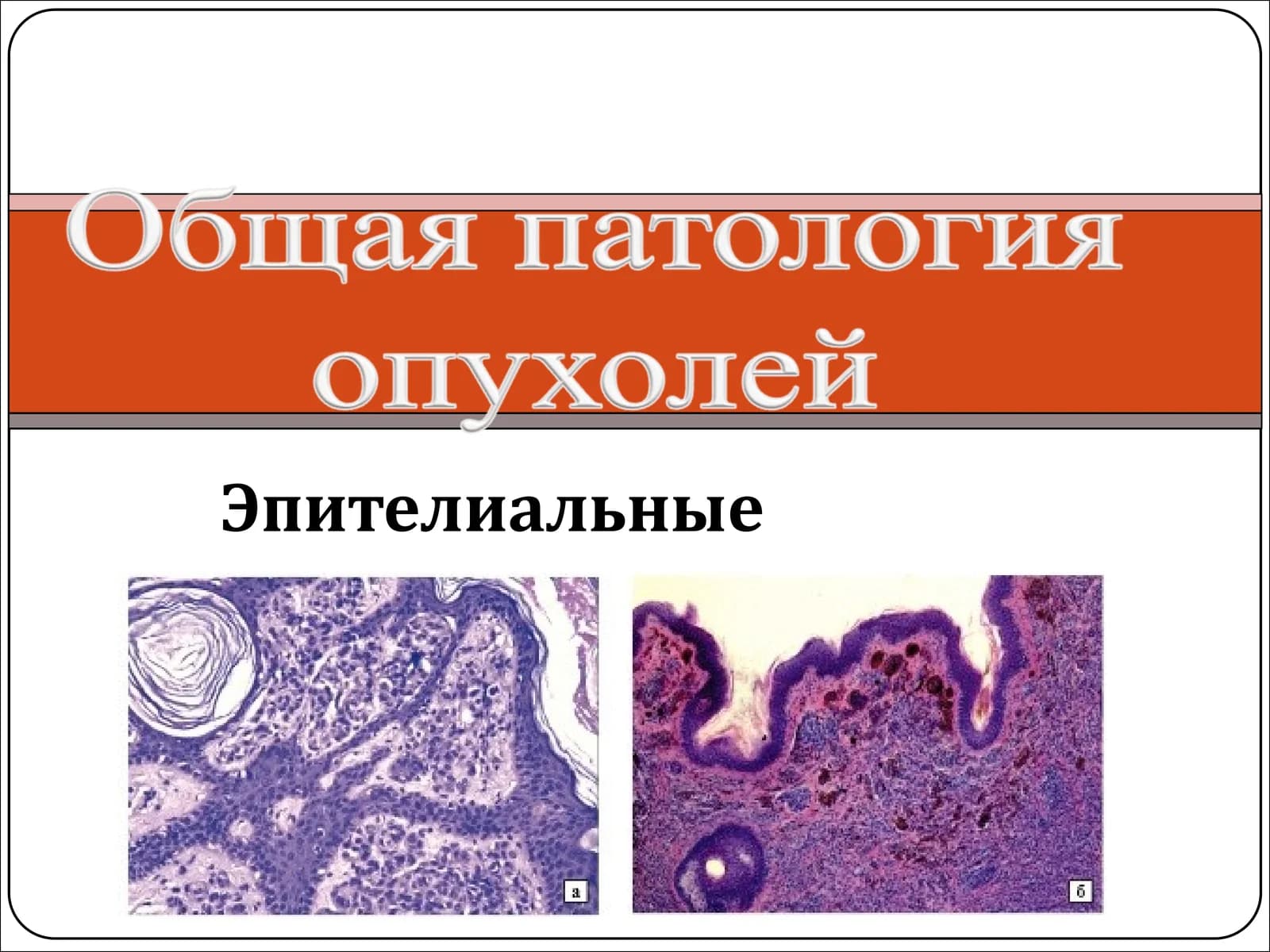 Эпителиальные опухоли