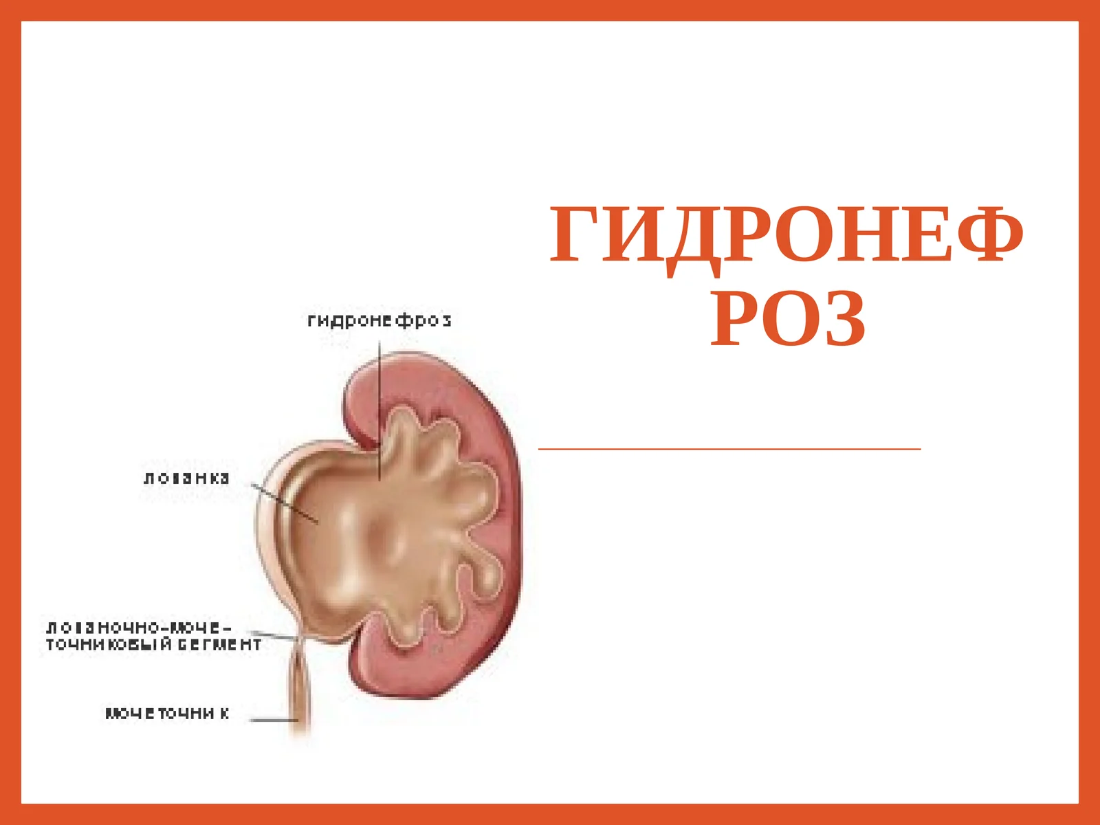 Гидронефроз
