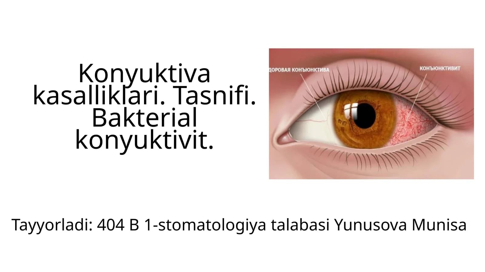 Konyuktivakasalliklari.Tasnifi.Bakterialkonyuktivit