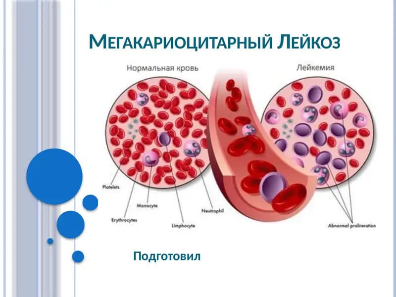 Острый мегакариоцитарный лейкоз