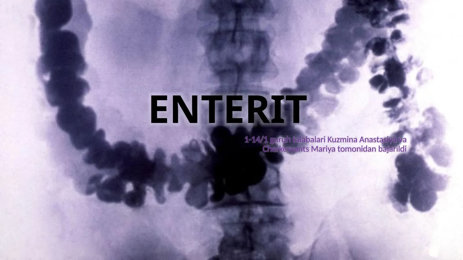 Enterit ingichka ichak yallig'lanishi (1-variant)