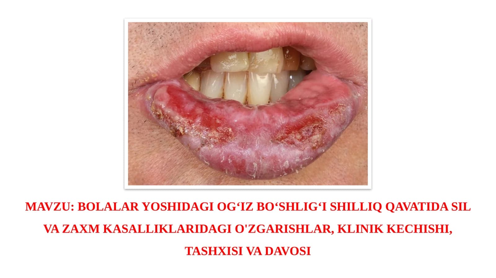BOLALAR YOSHIDAGI OG‘IZ BO‘SHLIG‘I SHILLIQ QAVATIDA SIL VA ZAXM KASALLIKLARIDAGI O'ZGARISHLAR, KLINIK KECHISHI, TASHXISI VA DAVOSI