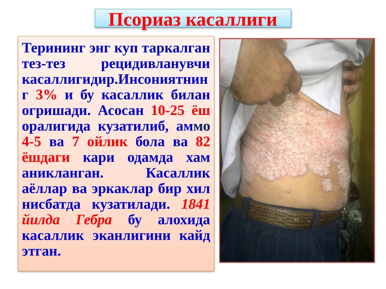 Псориаз касаллиги