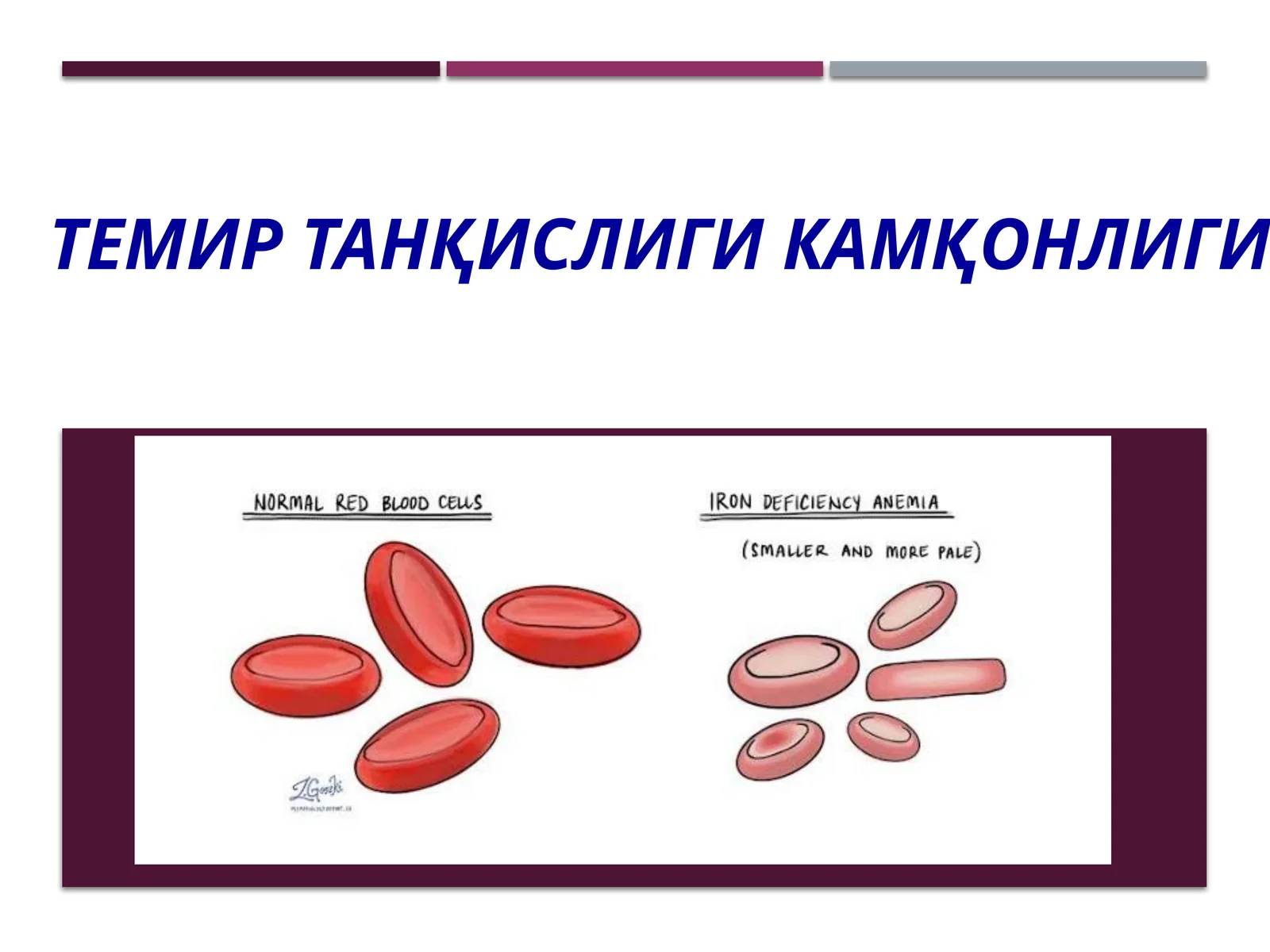 Темир танқислиги камқонлиги