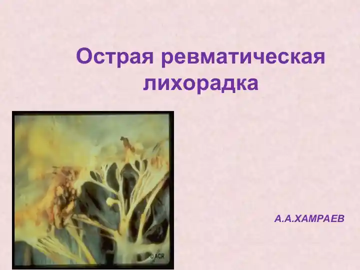 Острая ревматическая лихорадка