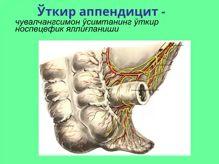 Ўткир аппендицит