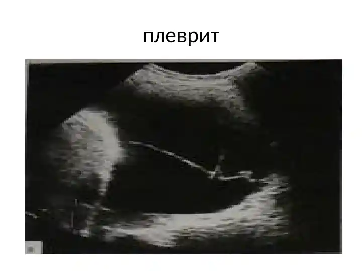 плеврит