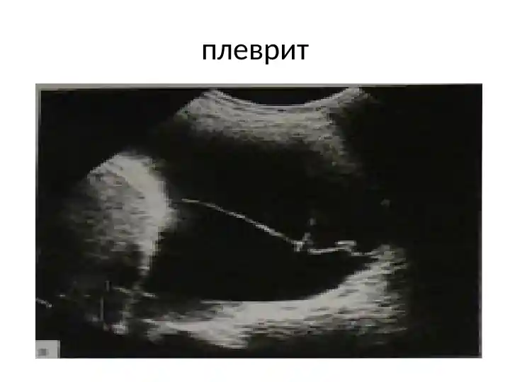 Плеврит