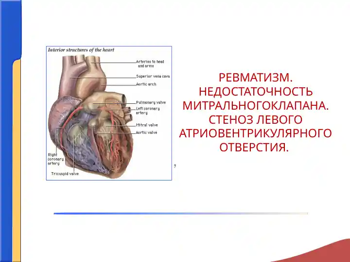 РЕВМАТИЗМ. НЕДОСТАТОЧНОСТЬ МИТРАЛЬНОГОКЛАПАНА. СТЕНОЗ ЛЕВОГО АТРИОВЕНТРИКУЛЯРНОГО ОТВЕРСТИЯ.