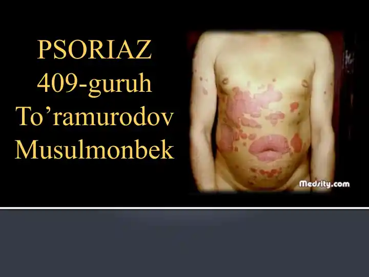 Psoriaz