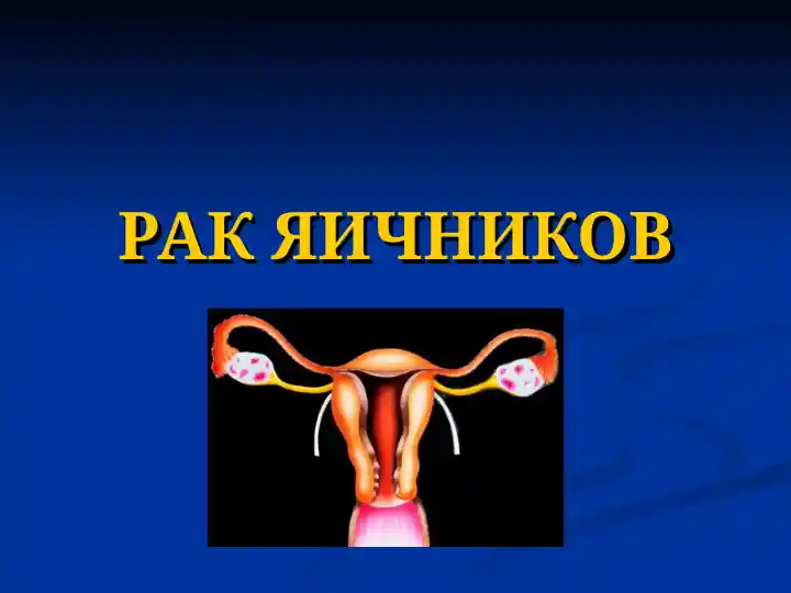 Рак Яичников
