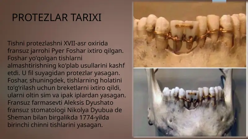 Ortopedik stomatologiyada protez turlari, protezlash