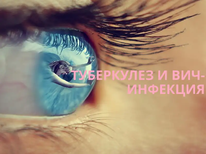 Туберкулез и ВИЧ-инфекция